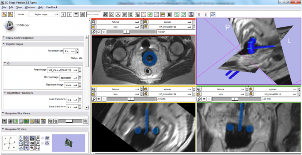 Registration of the applicator image to the patient image in 3D Slicer