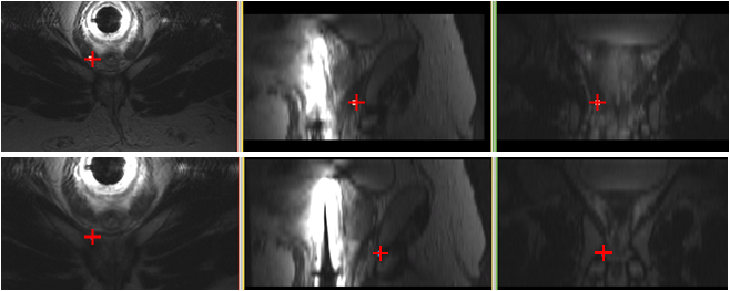 Biopsy target positions before and after tracking adjustments