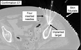 Confirmation CT of pilot needle insertion for MSK biopsy, in human cadaver