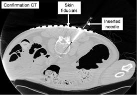 Confirmation CT of needle placement for spinal pain management, in cadaver